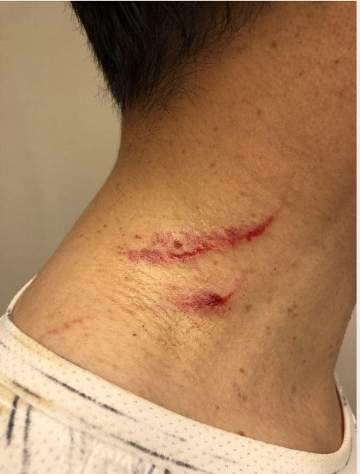 기동민 더불어민주당 의원은 10일 자신의 SNS를 통해 김경수 경남지사의 상처 사진을 공개했다.<기동민 더불어민주당 의원 페이스북 캡처>